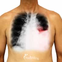 Lung Cancer Treatment in Mexico - Alternative Cancer Treatments